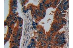 Detection of DISC1 in Human Colorectal cancer Tissue using Polyclonal Antibody to Disrupted In Schizophrenia 1 (DISC1)