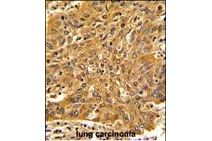 Formalin-fixed and paraffin-embedded human lung carcinoma with Fascin Antibody (Center), which was peroxidase-conjugated to the secondary antibody, followed by DAB staining. (Fascin antibody  (AA 322-350))