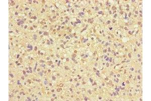 Immunohistochemistry of paraffin-embedded human glioma using ABIN7166372 at dilution of 1:100 (ZNF365 antibody  (AA 241-401))