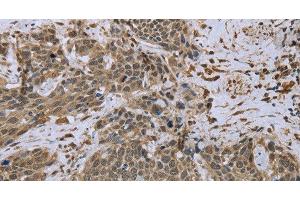 Immunohistochemistry of paraffin-embedded Human cervical cancer tissue using DCTN4 Polyclonal Antibody at dilution 1:50