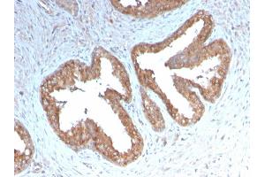 Formalin-fixed, paraffin-embedded human Prostate Carcinoma stained with COX-2 Recombinant Rabbit Monoclonal Antibody (COX2/3232R). (Recombinant PTGS2 antibody  (AA 442-572))