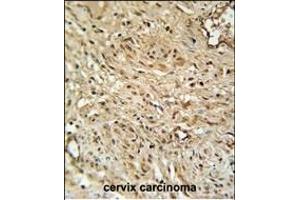 R Antibody (C-term) (ABIN651453 and ABIN2840247) immunohistochemistry analysis in formalin fixed and paraffin embedded human cervix carcinoma followed by peroxidase conjugation of the secondary antibody and DAB staining. (TWIST Neighbor antibody  (C-Term))