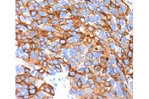 IHC testing in human melanoma stained with MART-1 antibody cocktail. (MLANA antibody)