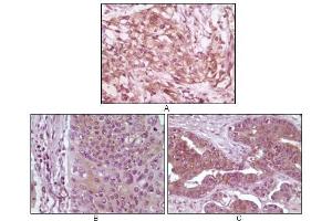 Immunohistochemical analysis of paraffin-embedded human pancreas carcinoma (A), esophagus carcinoma tissue (B) and ovary tumor tissue, showing cytoplasmic and membrane localization using 4E-BP1 antibody with DAB staining. (eIF4EBP1 antibody)