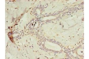 Immunohistochemistry of paraffin-embedded human breast cancer using ABIN7158845 at dilution of 1:100 (m-AAA Protease-Interacting Protein 1, Mitochondrial (MAIP1) (AA 97-291) antibody)