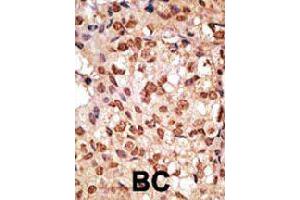 Formalin-fixed and paraffin-embedded human cancer tissue reacted with SIGLEC7 polyclonal antibody  , which was peroxidase-conjugated to the secondary antibody, followed by DAB staining. (SIGLEC7 antibody  (N-Term))