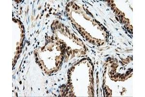 Immunohistochemical staining of paraffin-embedded Carcinoma of liver tissue using anti-LIPG mouse monoclonal antibody. (LIPG antibody)
