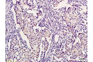 Formalin-fixed and paraffin embedded human breast cancer labeled with Anti-PHYH Polyclonal Antibody, Unconjugated  followed by conjugation to the secondary antibody and DAB staining (PHYH antibody  (AA 1-100))