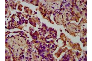 IHC image of ABIN7158078 diluted at 1:200 and staining in paraffin-embedded human lung cancer performed on a Leica BondTM system. (LGI4 antibody  (AA 292-412))