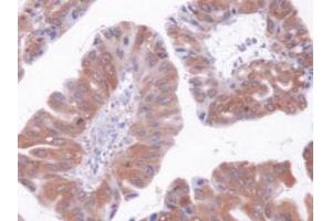 IHC-P analysis of Human Liver Cancer Tissue, with DAB staining. (GOT1 antibody  (AA 1-413))