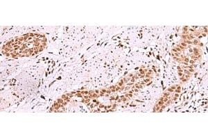 Immunohistochemistry of paraffin-embedded Human esophagus cancer tissue using ISL2 Polyclonal Antibody at dilution of 1:40(x200) (ISL2 antibody)
