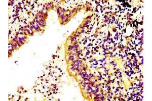IHC image of ABIN7168192 diluted at 1:400 and staining in paraffin-embedded human lung cancer performed on a Leica BondTM system.