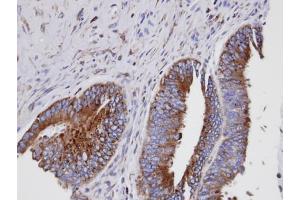 IHC-P Image Immunohistochemical analysis of paraffin-embedded human mixed ovarian cancer, using GIT1, antibody at 1:100 dilution.
