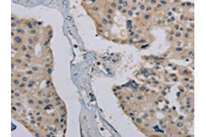 The image on the left is immunohistochemistry of paraffin-embedded Human prostate cancer tissue using ABIN7191867(PHKG1 Antibody) at dilution 1/20, on the right is treated with synthetic peptide. (PHKG1 antibody)