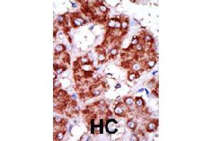 Formalin-fixed and paraffin-embedded human hepatocellular carcinoma tissue reacted with CPT1B polyclonal antibody  , which was peroxidase-conjugated to the secondary antibody, followed by DAB staining . (CPT1B antibody  (C-Term))