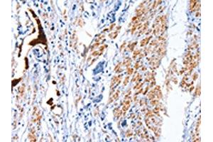 The image on the left is immunohistochemistry of paraffin-embedded Human prostate cancer tissue using ABIN7128792(CATSPER1 Antibody) at dilution 1/40, on the right is treated with fusion protein. (CATSPER1 antibody)