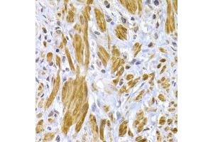 Immunohistochemistry of paraffin-embedded human gastric cancer using DSP antibody (ABIN6291454) at dilution of 1:100 (40x lens). (Desmoplakin antibody)