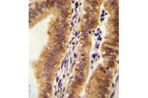 Immunohistochemistry analysis in formalin fixed and paraffin embedded human uterus tissue reacted with KIAA1609 Antibody (C-term) followed which was peroxidase conjugated to the secondary antibody and followed by AB staining. (KIAA1609 antibody  (C-Term))