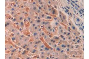 IHC-P analysis of Human Liver cancer Tissue, with DAB staining. (SIGLEC12 antibody  (AA 22-218))