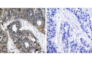 Peptide - +Immunohistochemical analysis of paraffin-embedded human breast carcinoma tissue using HSP27 (Ab-82) (Ab-232) antibody (#B7112). (HSP27 antibody  (pSer82))