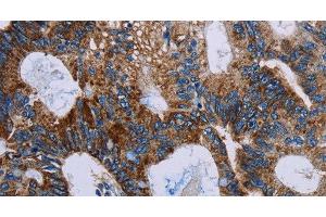 Immunohistochemistry of paraffin-embedded Human colon cancer using JAM-A Polyclonal Antibody at dilution of 1:40 (F11R antibody)