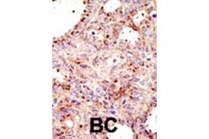 Formalin-fixed and paraffin-embedded human cancer tissue reacted with the primary antibody, which was peroxidase-conjugated to the secondary antibody, followed by AEC staining. (ARFGAP1 antibody  (C-Term))