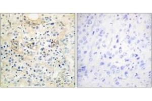 Immunohistochemistry analysis of paraffin-embedded human prostate carcinoma tissue, using TM16G Antibody. (Anoctamin 7 antibody  (AA 881-930))