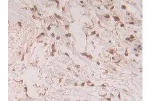 IHC-P analysis of Human Breast Cancer Tissue, with DAB staining. (S100A11 antibody  (AA 1-105))