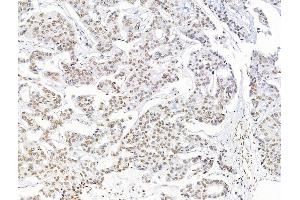 ABIN7094711 and ABIN7098762 at 1/100 staining Human breast cancer by IHC-P.