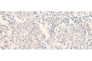 Immunohistochemistry of paraffin-embedded Human cervical cancer tissue using ADGRE3 Polyclonal Antibody at dilution of 1:35(x200) (EMR3 antibody)