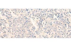 Immunohistochemistry of paraffin-embedded Human cervical cancer tissue using ADGRE3 Polyclonal Antibody at dilution of 1:35(x200) (EMR3 antibody)