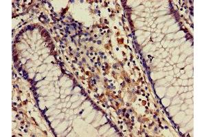 Immunohistochemistry of paraffin-embedded human colon cancer using ABIN7145576 at dilution of 1:100 (ATIC antibody  (AA 301-592))