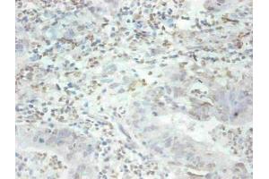 Immunohistochemical of paraffin-embedded human breast cancer tissue using ABIN7159679 at dilution of 1:200 (MFGE8 antibody)