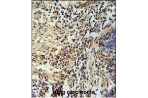 ZN Antibody (Center) (ABIN654974 and ABIN2844614) immunohistochemistry analysis in formalin fixed and paraffin embedded human lung carcinoma followed by peroxidase conjugation of the secondary antibody and DAB staining. (ZNF720 antibody  (AA 34-62))
