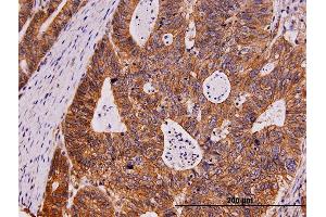 Immunoperoxidase of monoclonal antibody to KIT on formalin-fixed paraffin-embedded human stomach carcinoma. (KIT antibody  (AA 41-140))