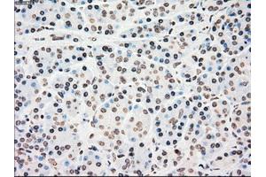 Immunohistochemical staining of paraffin-embedded colon tissue using anti-CHEK2mouse monoclonal antibody. (CHEK2 antibody)