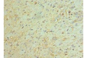 Immunohistochemistry of paraffin-embedded human glioma using ABIN7145171 at dilution of 1:100 (BCL11A antibody  (AA 1-230))