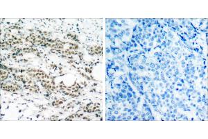 P-Peptide - +Immunohistochemical analysis of paraffin- embedded human breast carcinoma tissue using AFX (phospho-Ser197) antibody. (FOXO4 antibody  (pSer197))