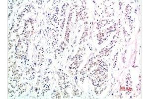 Immunohistochemical analysis of paraffin-embedded Human Stomach Carcinoma Tissue using Phospho-Smad3(S425) Mouse mAb diluted at 1:200. (Phospho-SMAD3(S425) (pSer425) antibody)