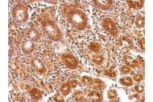 IHC-P Image ATP5A1 antibody [C2C3], C-term detects ATP5A1 protein at cytosol on human colon carcinoma by immunohistochemical analysis. (ATP5A1 antibody  (C-Term))