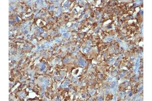Formalin-fixed, paraffin-embedded human Histiocytoma stained with CD68 Mouse Monoclonal Antibody (C68/684). (CD68 antibody)