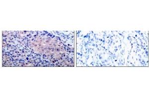 Immunohistochemical analysis of paraffin-embedded human breast carcinoma tissue using IκB-α (Ab- 32/36) antibody (E021122). (NFKBIA antibody)