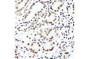 Immunohistochemical analysis of KLF4 staining in human stomach cancer formalin fixed paraffin embedded tissue section. (KLF4 antibody)