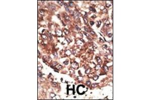 Formalin-fixed and paraffin-embedded human cancer tissue reacted with the primary antibody, which was peroxidase-conjugated to the secondary antibody, followed by AEC staining. (MMP13 antibody  (C-Term))