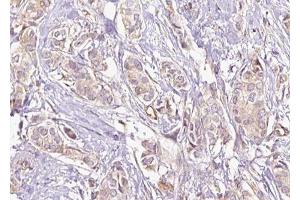ABIN6274885 at 1/100 staining Human breast cancer tissue by IHC-P. (ABCD4 antibody  (Internal Region))