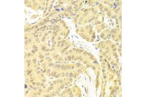 Immunohistochemistry of paraffin-embedded human thyroid cancer using CFLAR antibody at dilution of 1:100 (x400 lens).