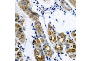 Immunohistochemical analysis of SerRS staining in human gastric cancer formalin fixed paraffin embedded tissue section. (Seryl-tRNA Synthetase (SARS) antibody)