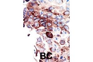 Formalin-fixed and paraffin-embedded human cancer tissue reacted with the primary antibody, which was peroxidase-conjugated to the secondary antibody, followed by DAB staining. (AXL antibody  (C-Term))