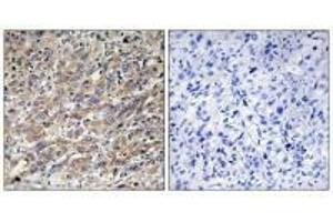 Immunohistochemistry analysis of paraffin-embedded human liver carcinoma tissue using COX17 antibody. (COX17 antibody  (N-Term))