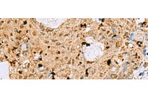 Immunohistochemistry of paraffin-embedded Human ovarian cancer tissue using MAF Polyclonal Antibody at dilution of 1:25(x200) (MAF antibody)